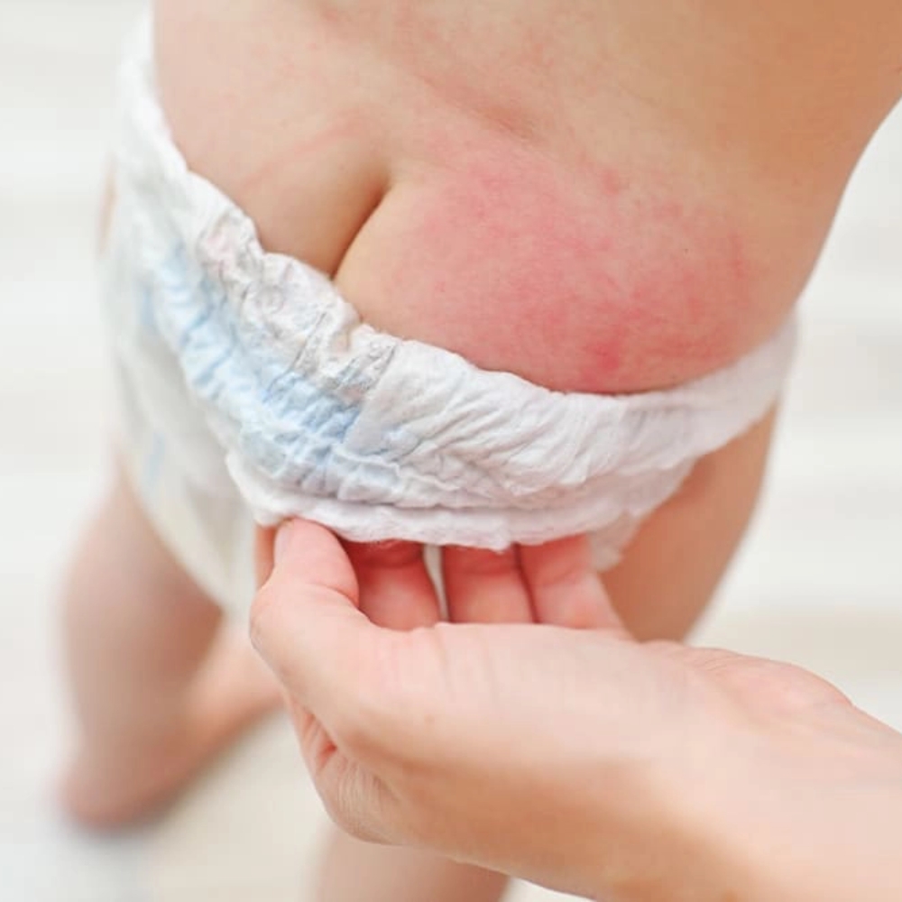 Hăm Tã – Ác Mộng Của Các Bà Mẹ Bỉm Sữa
